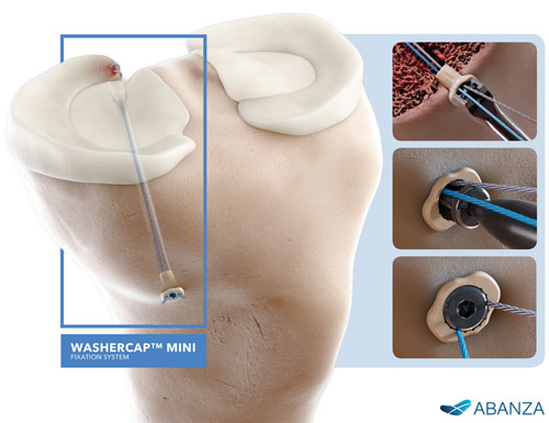 ABANZA receives FDA 510(k) clearance for WasherCap™ Mini implantable fixation device