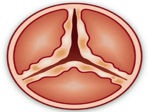 Aortic Valve Stenosis 