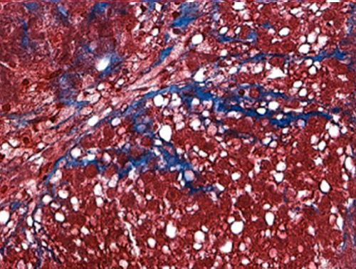 Viscient Bioprinted Liver Tissue Showing MASH Disease 