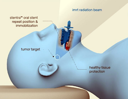 Stentra infographic 