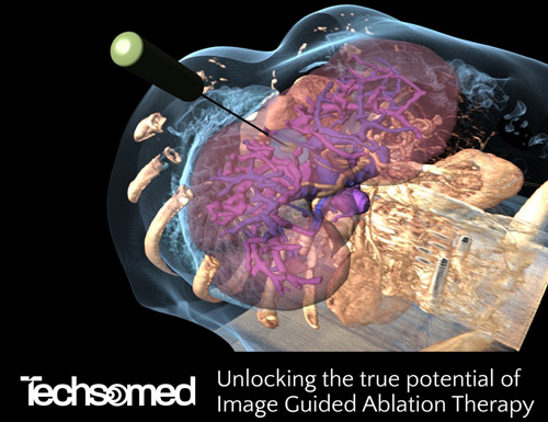 Techsomed announces U.S. launch of BioTraceIO Vision and BioTraceIO Precision software for image-guided ablation therapy